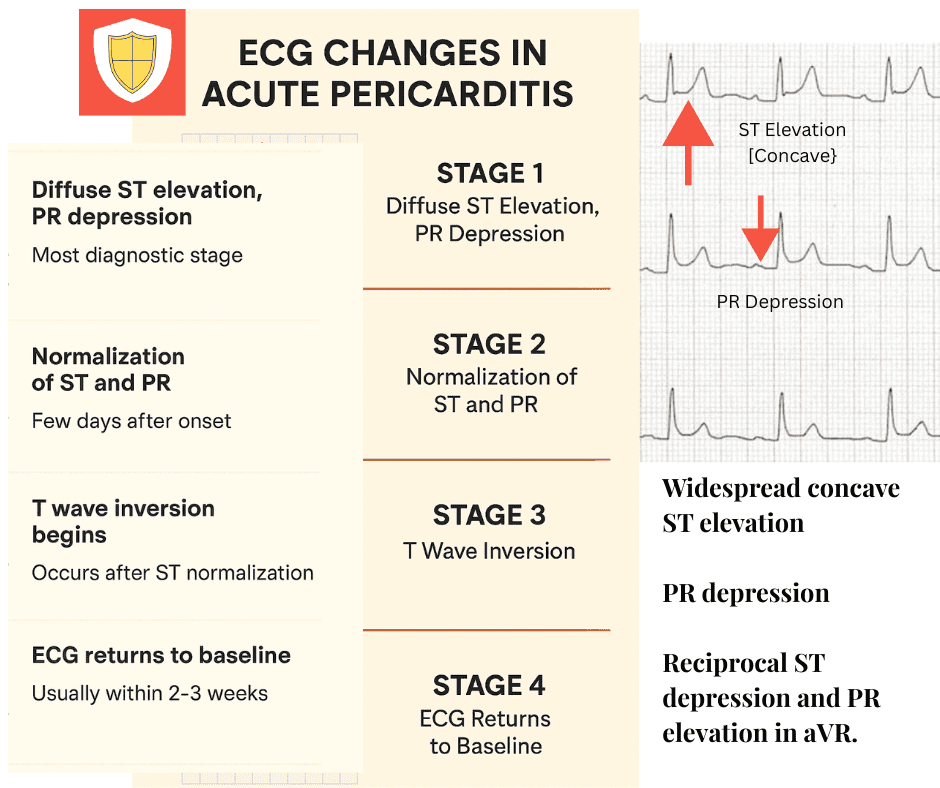 ECG in acute pericarditis,,PR depression ECG,,Pericarditis vs STEMI,,ST elevation concave,,ECG stages of pericarditis,,ST/T ratio in V6,,T wave inversion pericarditis,,PR elevation in aVR