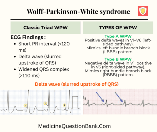 Types of Wolff–Parkinson–White (WPW) syndrome - Medicine Question Bank